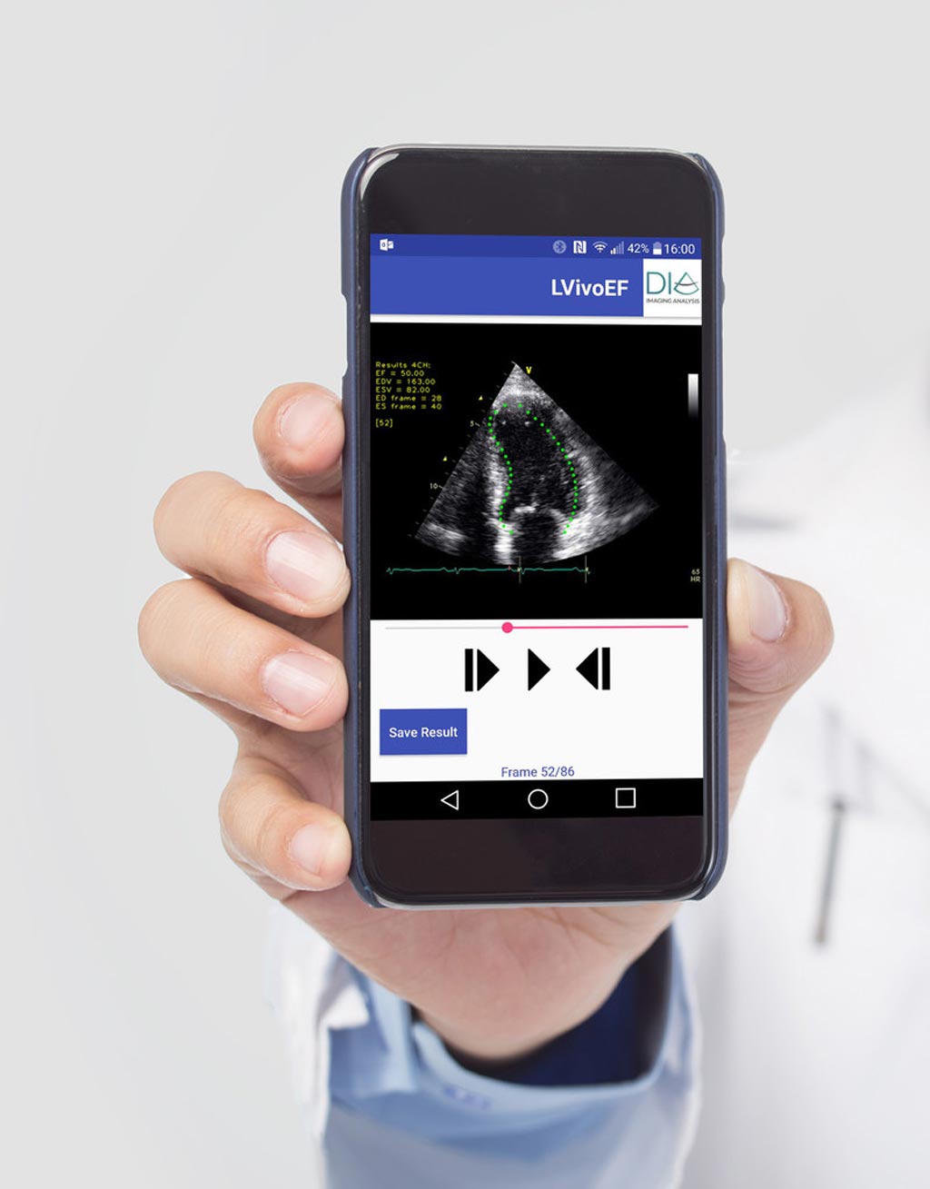 Image: Automated tools for ultrasound analysis on mobile devices (Photo courtesy of DiA).