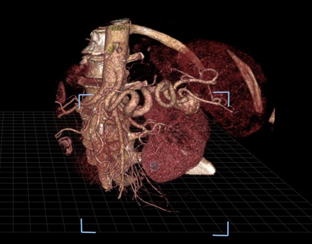 Image: An image of a splenic artery aneurysm as seen in virtual reality (Photo courtesy of SIR).