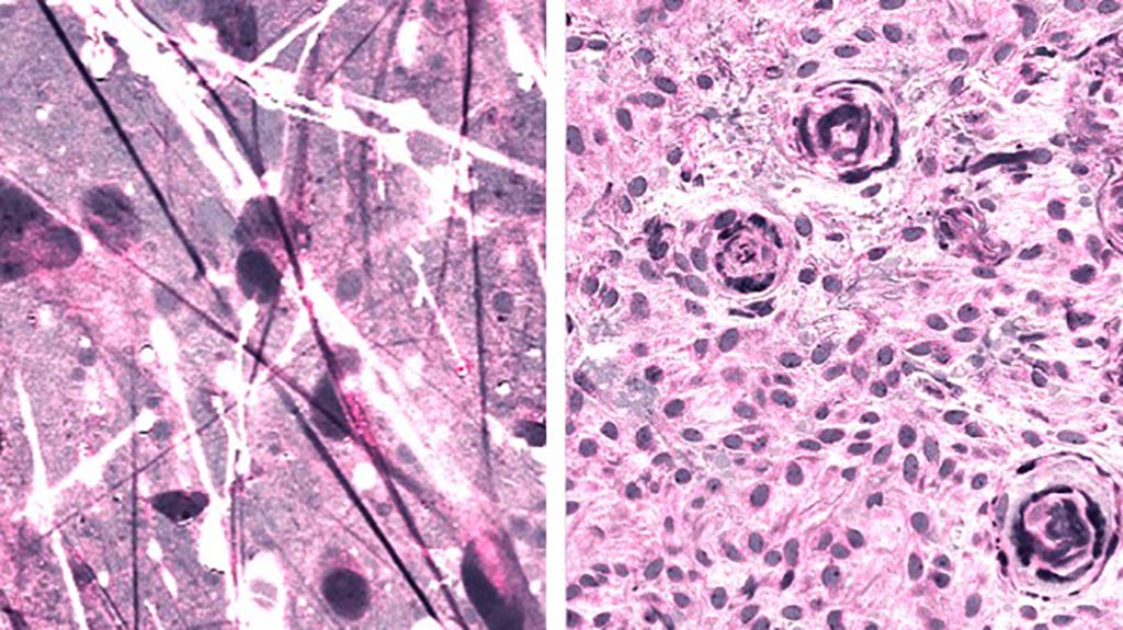 Image: Stimulated Raman histologic images of diffuse astrocytoma (left) and meningioma (right) (Photo courtesy of Daniel Orringer).