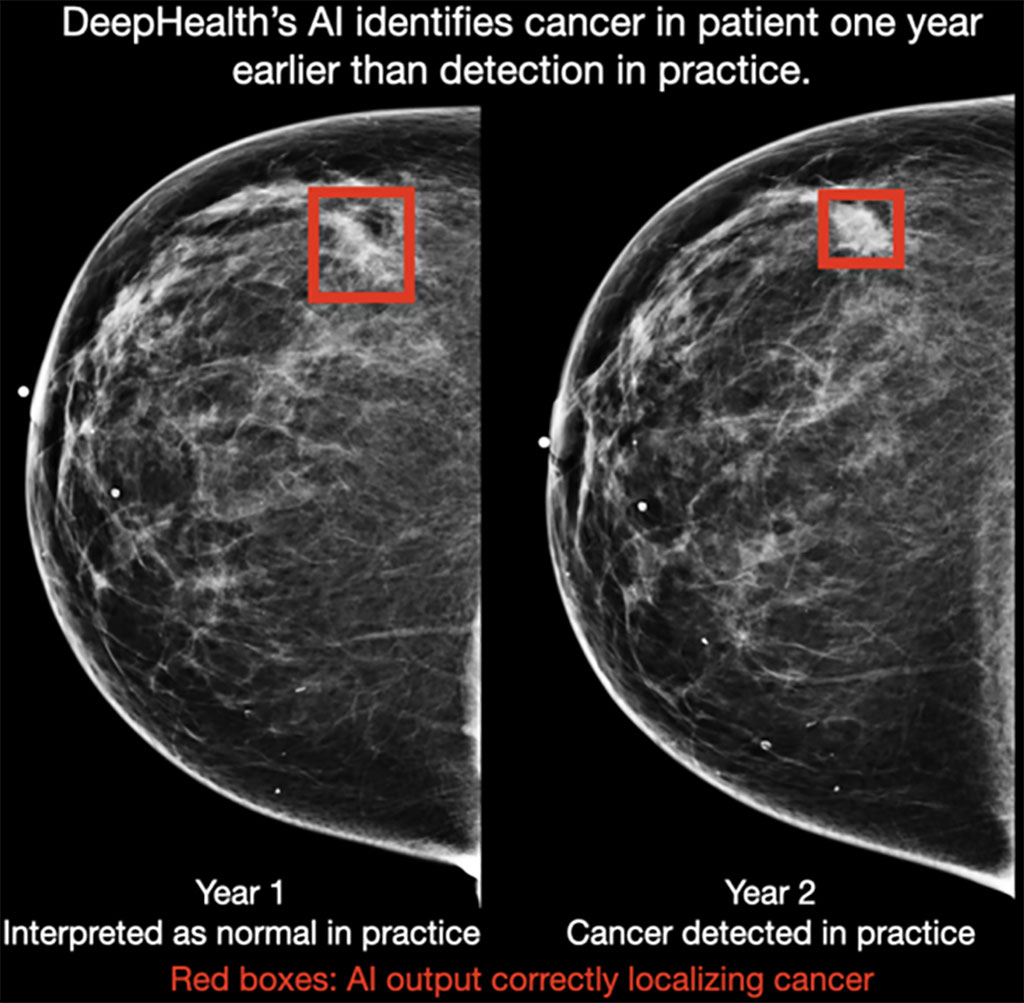 Image: DeepHealth`s AI identifies cancer in a patient one year earlier than detected in practice (Photo courtesy of DeepHealth)
